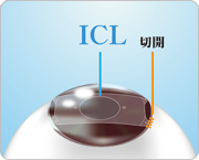 フェイキックIOL（ICL）の手術方法2