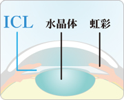 フェイキックIOL（ICL）の手術方法3